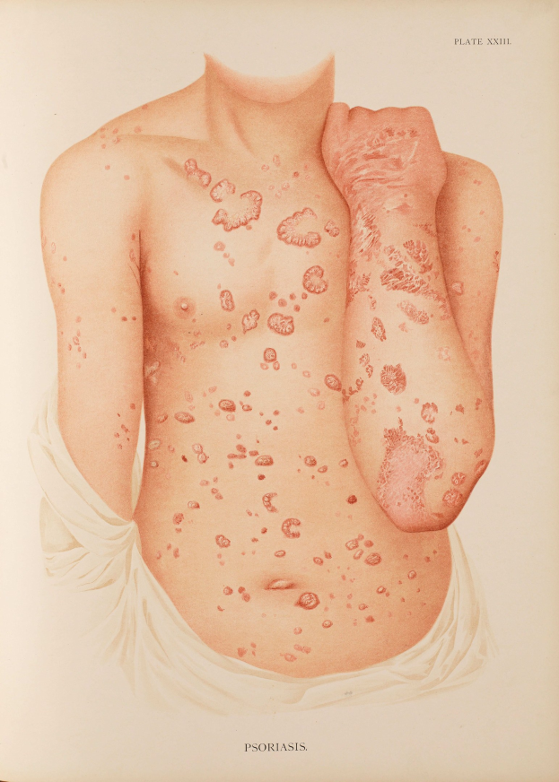 Ein Buchumschlag mit einer Illustration eines Männerkörpers mit roten Flecken, die wahrscheinlich Psoriasis darstellen, neben Text, der Informationen zum Zustand bereitstellt.